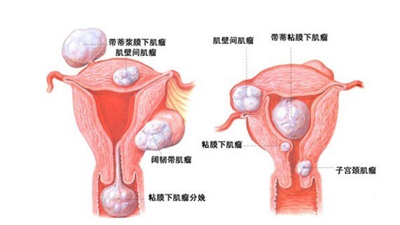 孕前查出子宫肌：先切除肌，还是先怀孕？