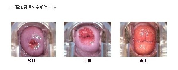 宫颈糜烂怎么治疗